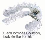 descriptive image about clear braces in Houston